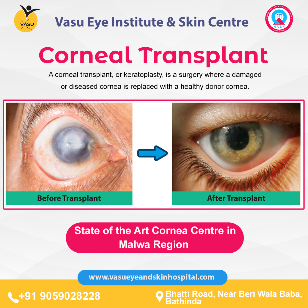 cornea clinic at Best Eye Hospital in Bathinda