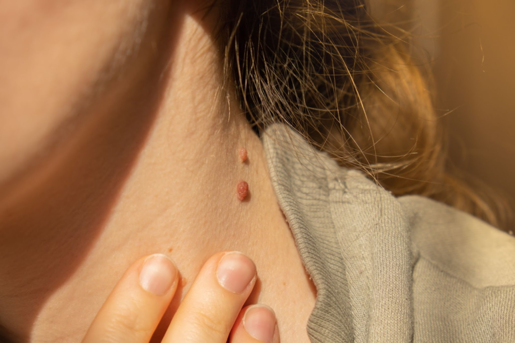 Warts Skin tags removal Bathinda