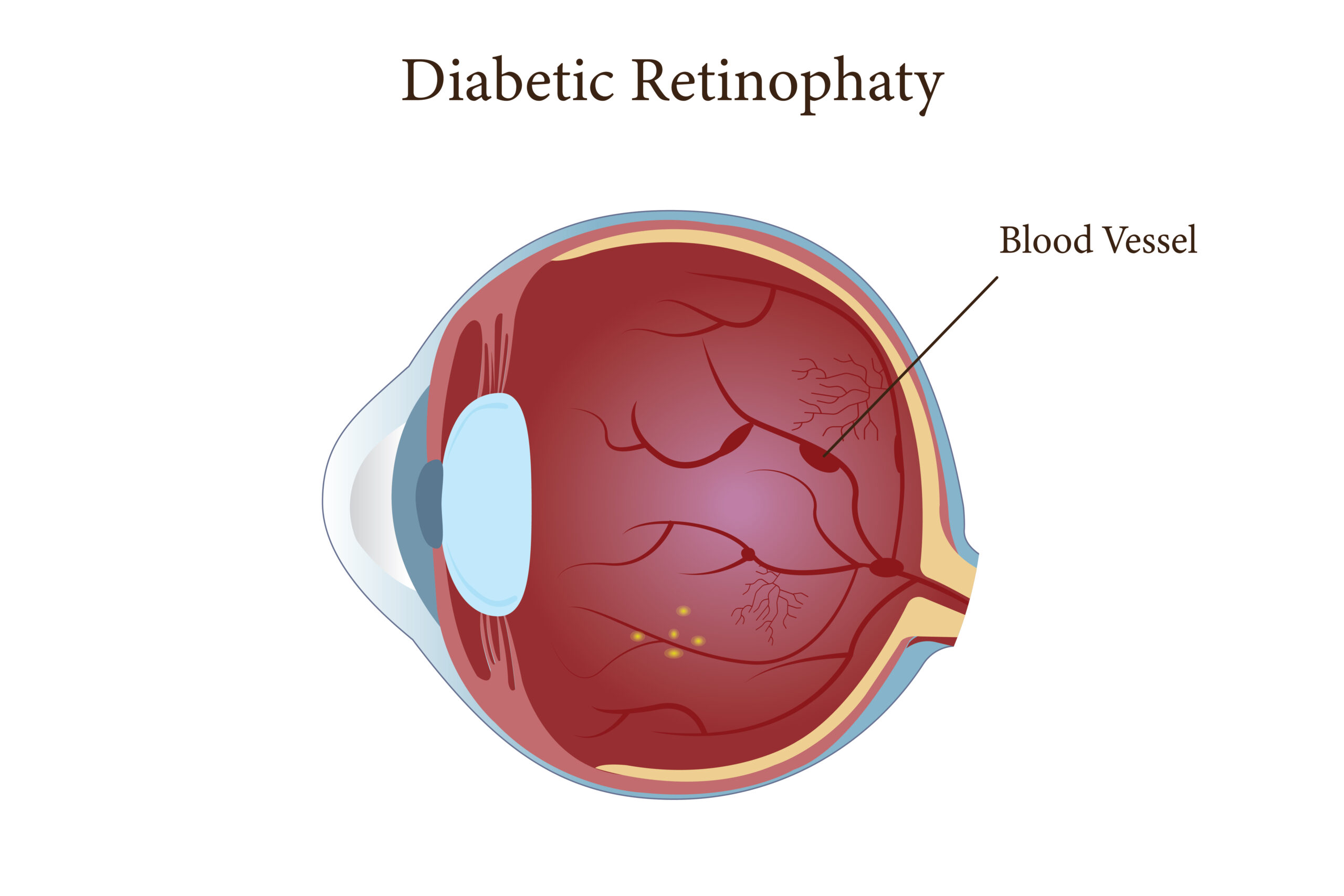 Diabetic Retinopathy