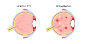 How Diabetes Affects the Retina (And How to Prevent Vision Loss)
