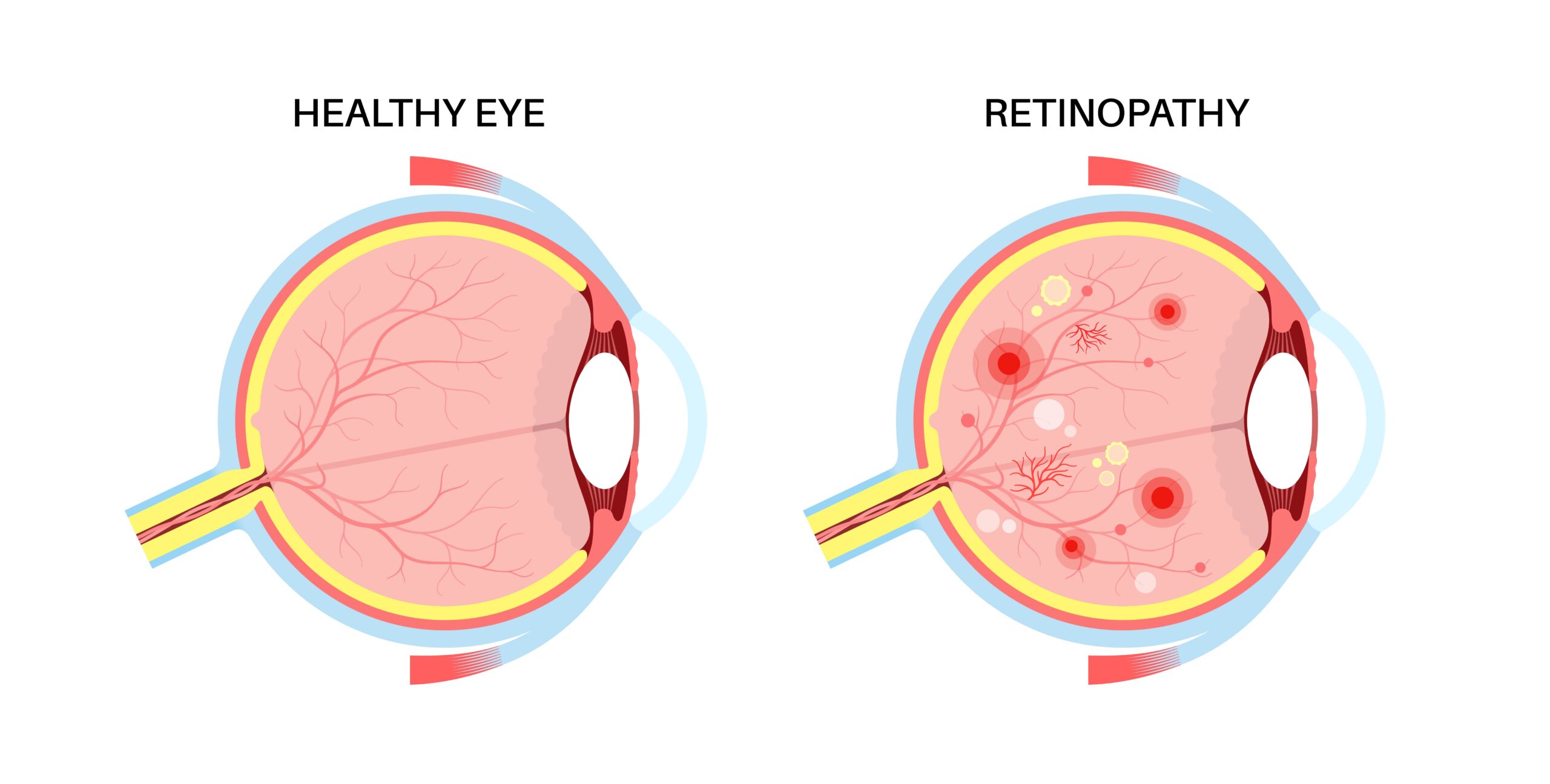 How Diabetes Affects the Retina (And How to Prevent Vision Loss)