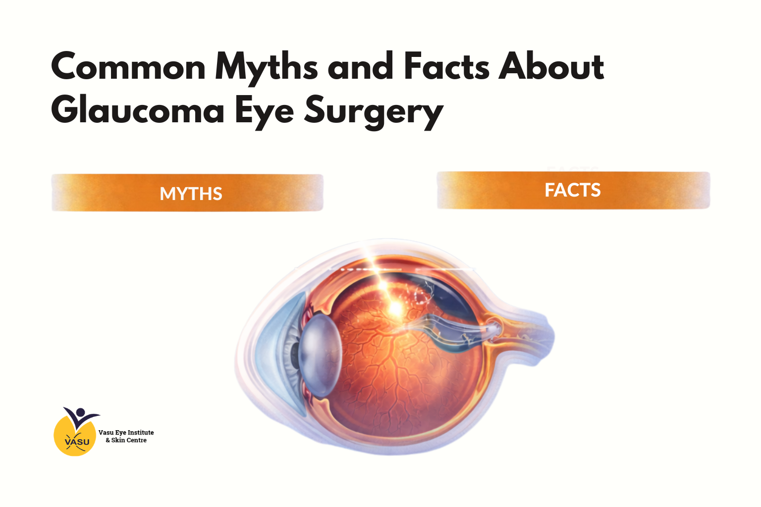 Common Myths and Facts About Glaucoma Eye Surgery