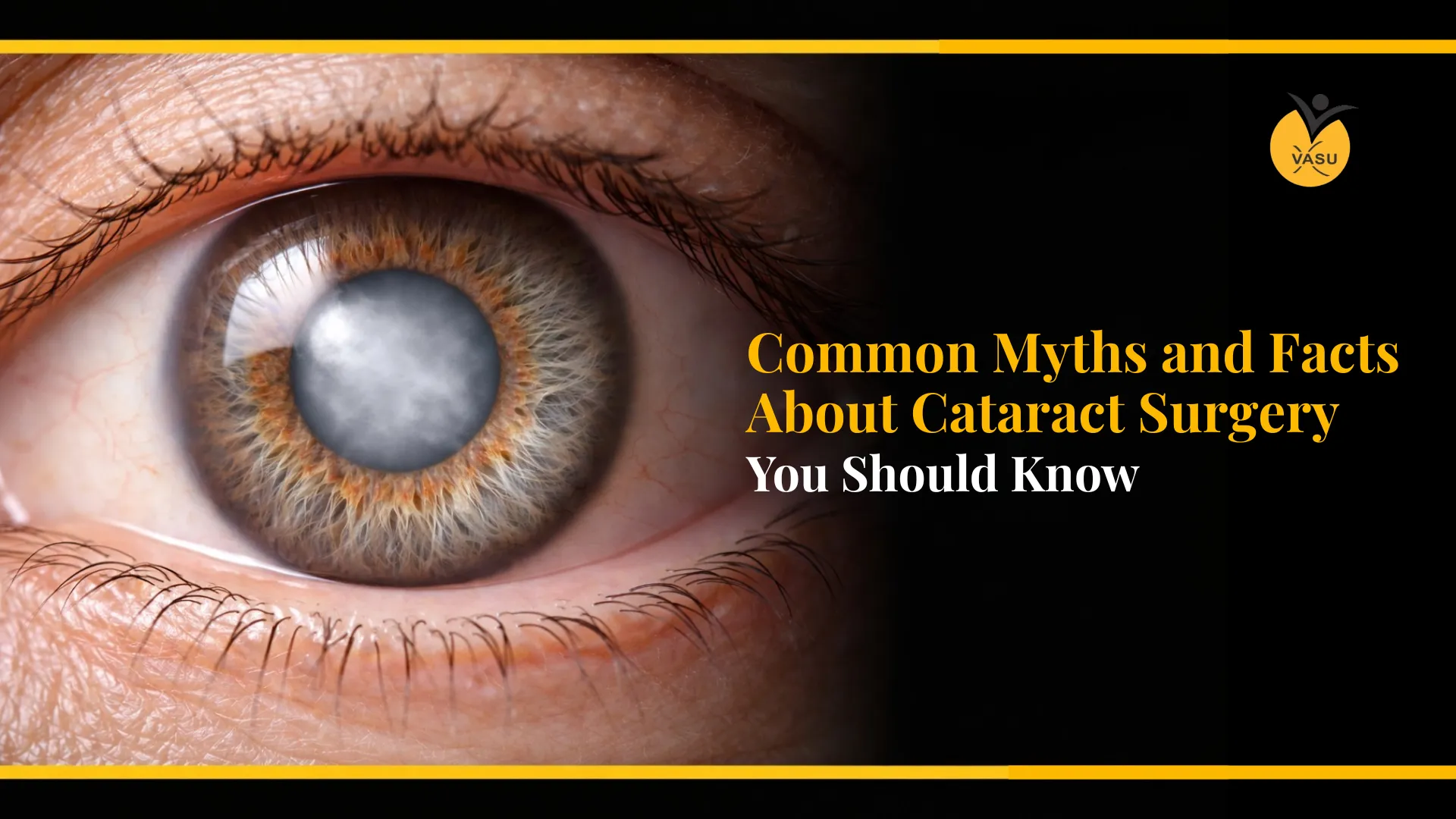 Common Myths and Facts About Cataract Surgery You Should Know