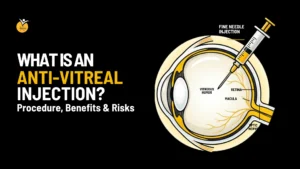 What is an Anti-Vitreal Injection? Procedure, Benefits & Risks