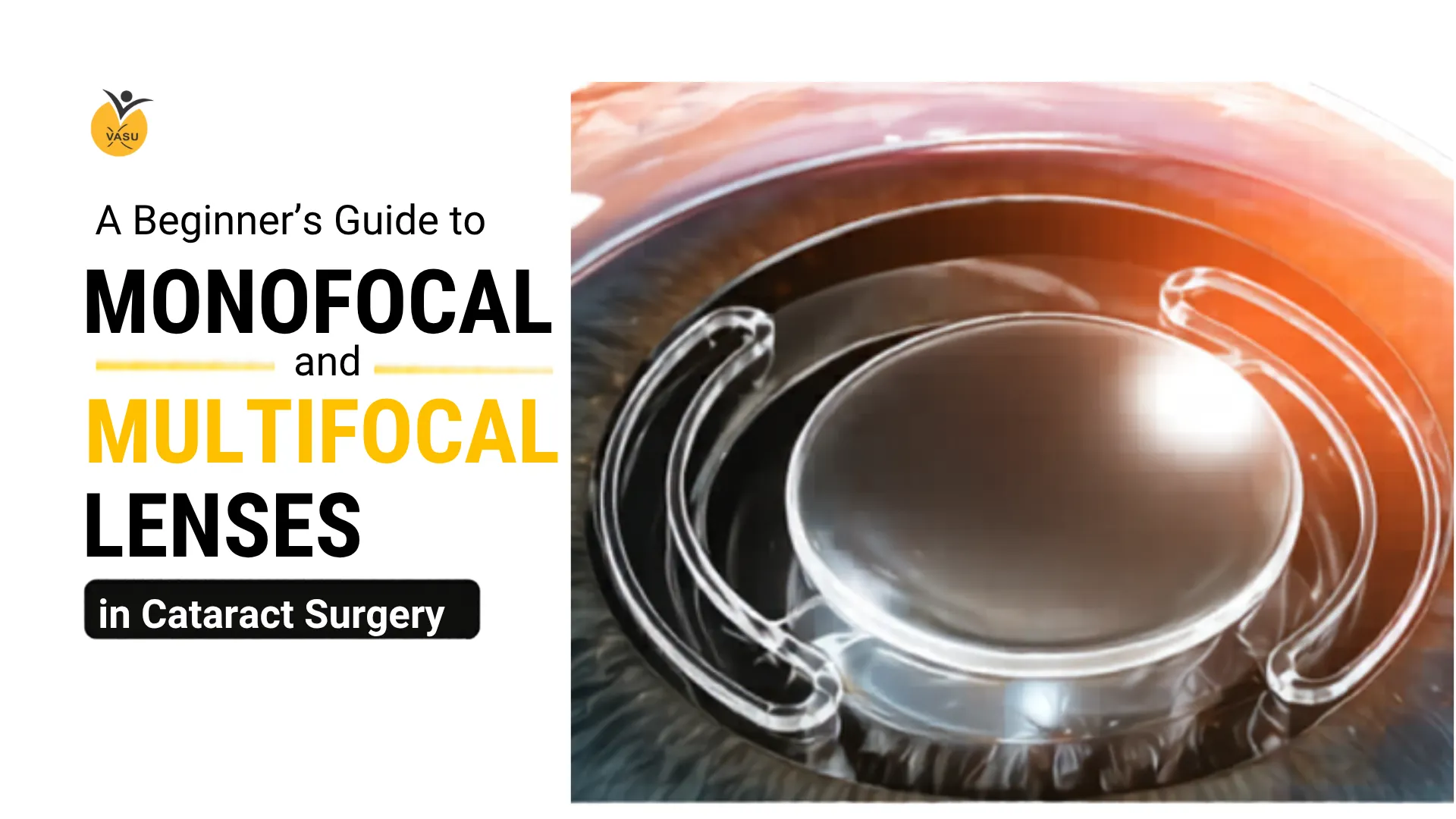 A Beginner’s Guide to Monofocal and Multifocal Lenses in Cataract Surgery