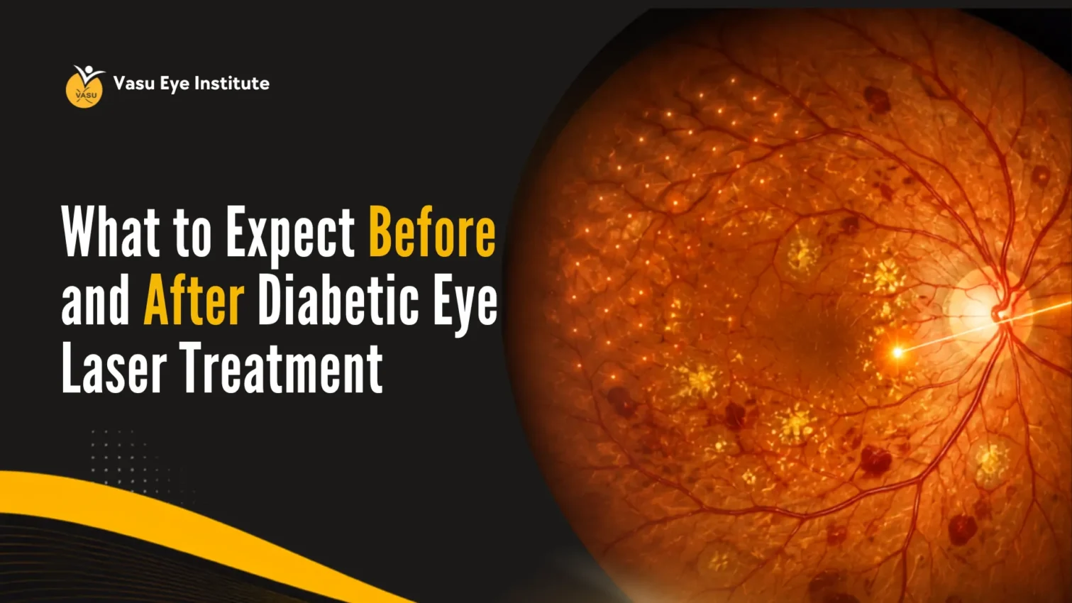 What to Expect Before and After Diabetic Eye Laser Treatment