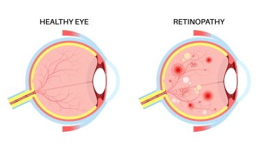 How Diabetes Affects the Retina (And How to Prevent Vision Loss)