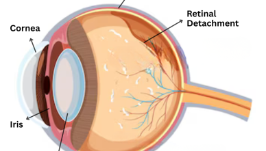 Early Signs of Retina Damage You Should Never Ignore