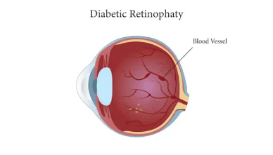 Laser, Injections, or Surgery: Which Is Best for Diabetic Retinopathy?