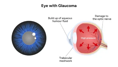 Glaucoma and Diabetes: How They Are Connected & What You Should Do