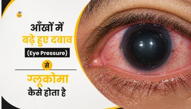 आँखों में बढ़े हुए दबाव (Eye Pressure) से ग्लूकोमा कैसे होता है