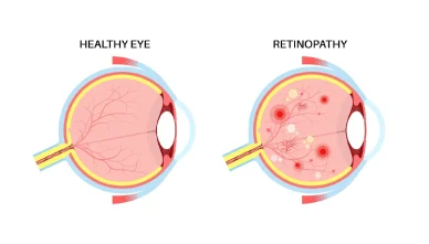 How Diabetes Affects the Retina (And How to Prevent Vision Loss)