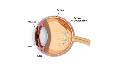 Early Signs of Retina Damage You Should Never Ignore