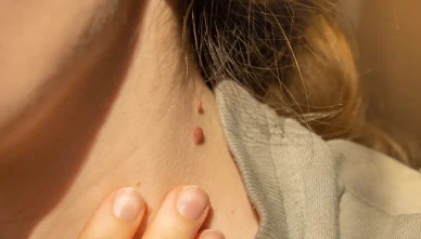 Warts Skin tags removal Bathinda